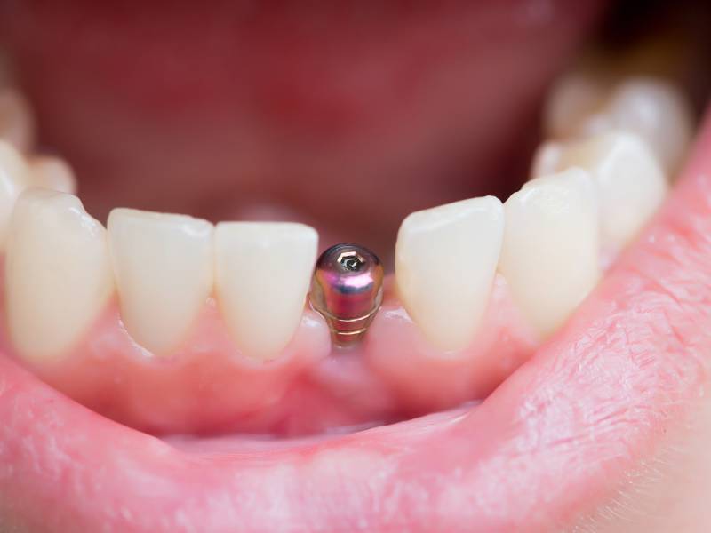 5 питань стоматологу, які ставлять перед встановленням імплантів